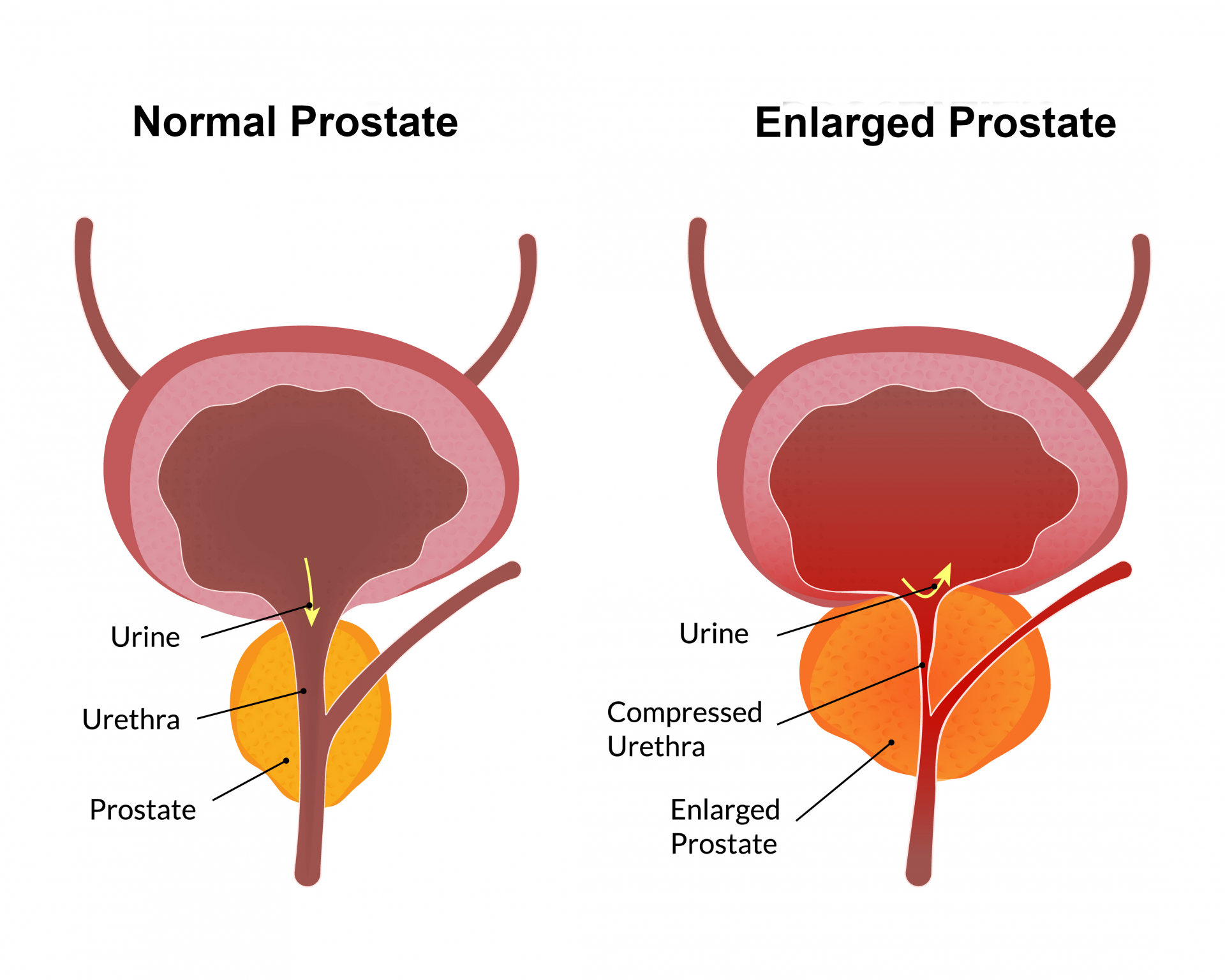 Prostate Infographic (1) 